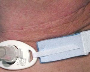SUN MED AirLife® Tracheostomy Tube Holder RES242A